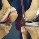 When Do You Need Knee Replacement Surgery? Expert Advice from Orthopedic Doctors in Varanasi