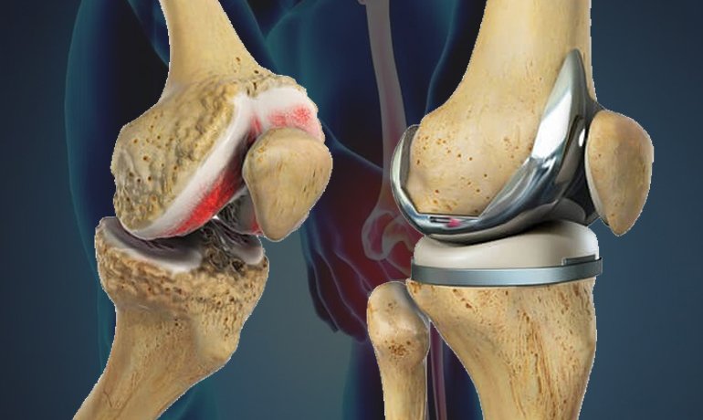 When Do You Need Knee Replacement Surgery? Expert Advice from Orthopedic Doctors in Varanasi